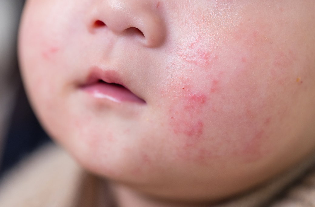 Prvi znaci atopije: Da li moja beba ima atopičnu kožu?